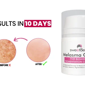 SWEET8EEN MELASMA CREAM 30ML
